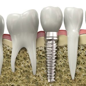 Implant Dentar Constanta - ToldiMED