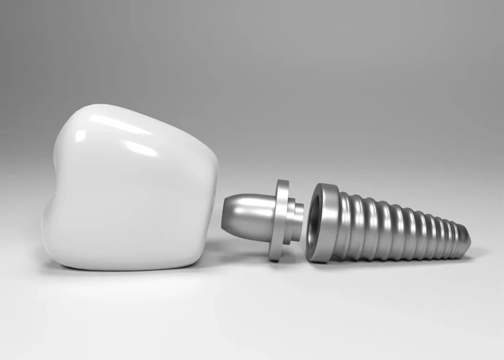 Când nu se poate face implant dentar: contraindicații și riscuri principale