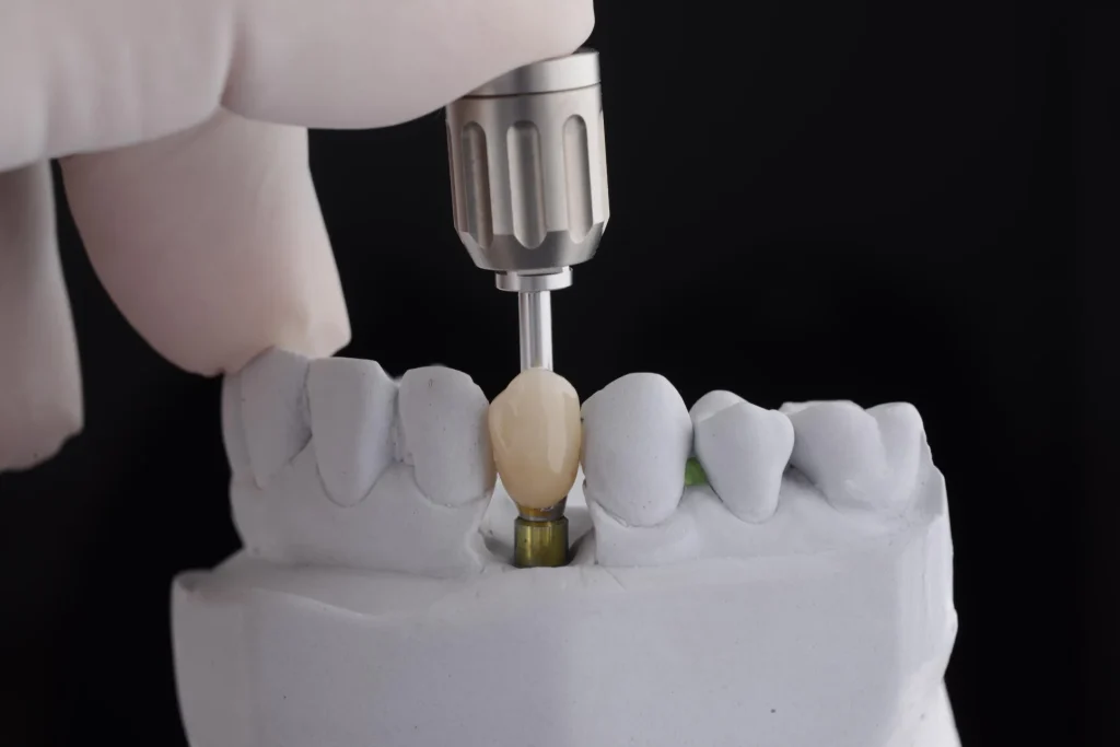 Recuperare după implant dentar – ghid complet pentru pacienți