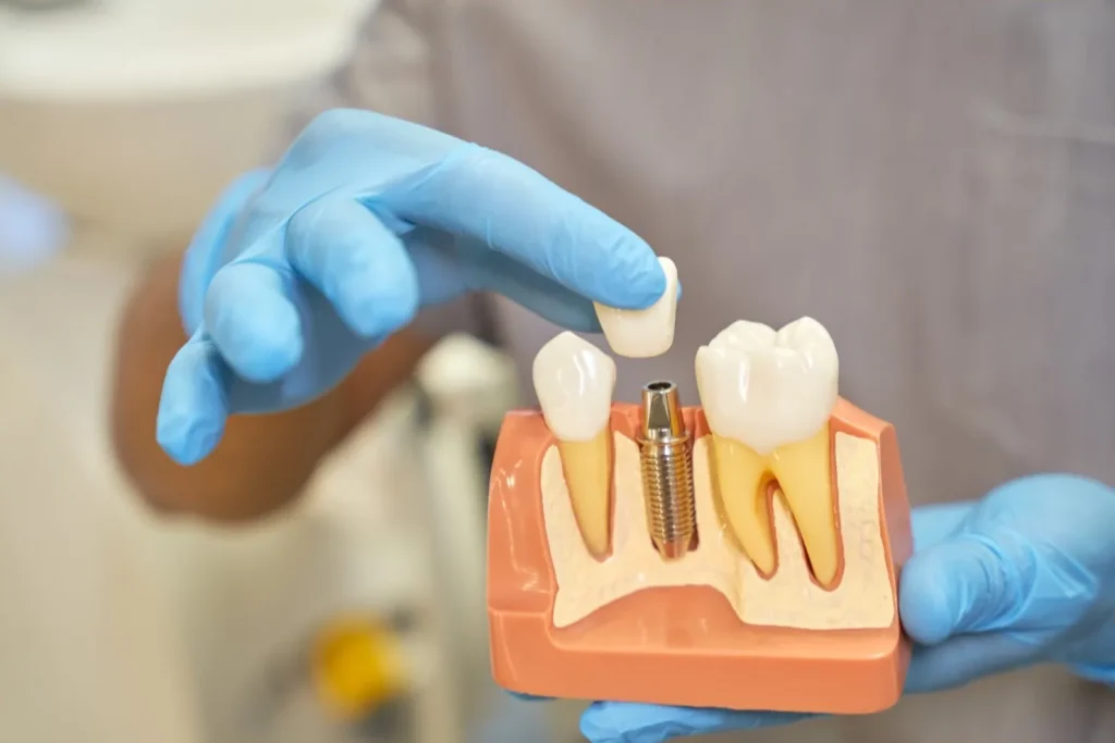 Respingerea implantului dentar: simptome, cauze și tratament pentru periimplantită și infecții dentare