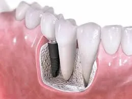 Totul despre implanturile dentare