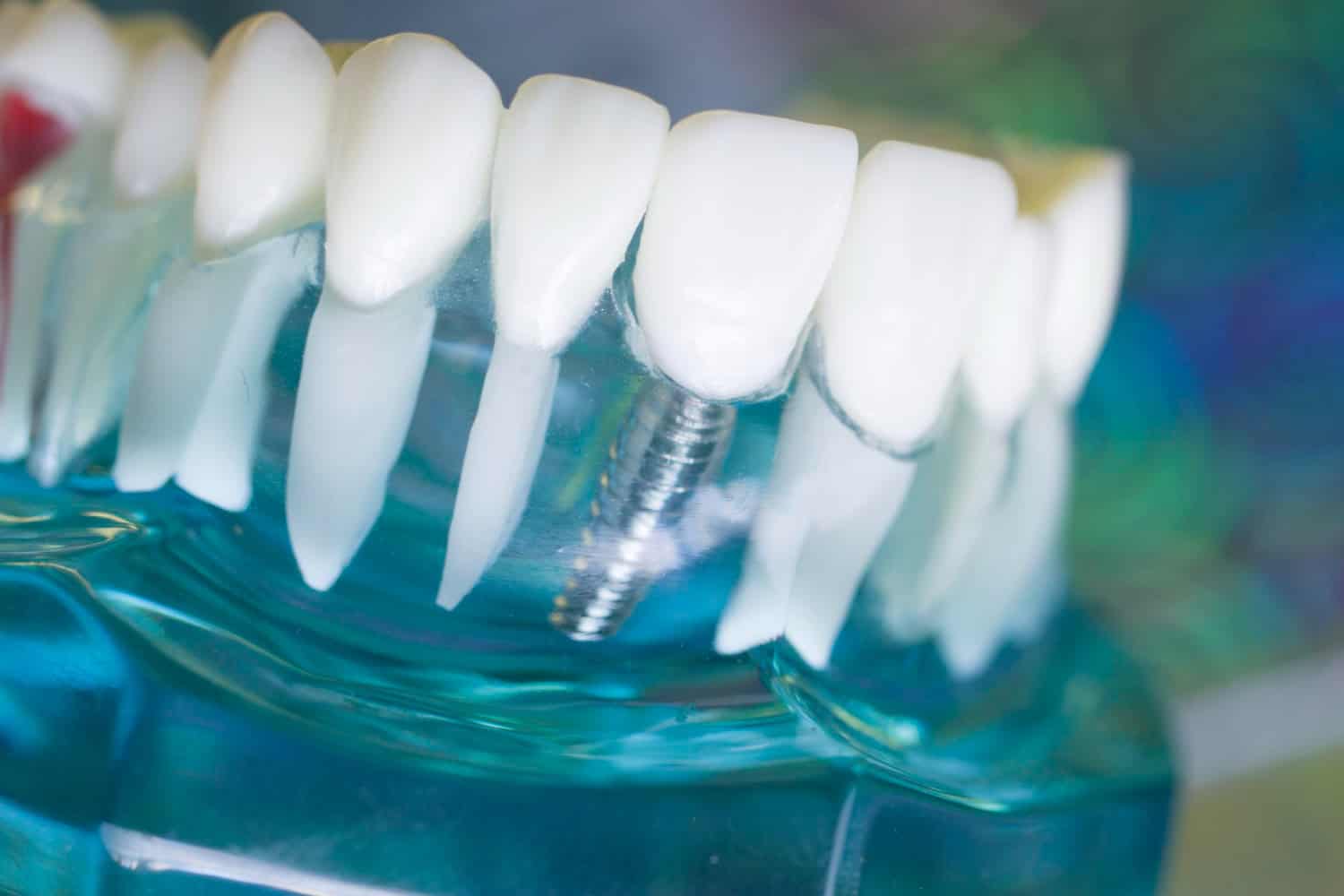 La cât timp se poate mânca după implant dentar