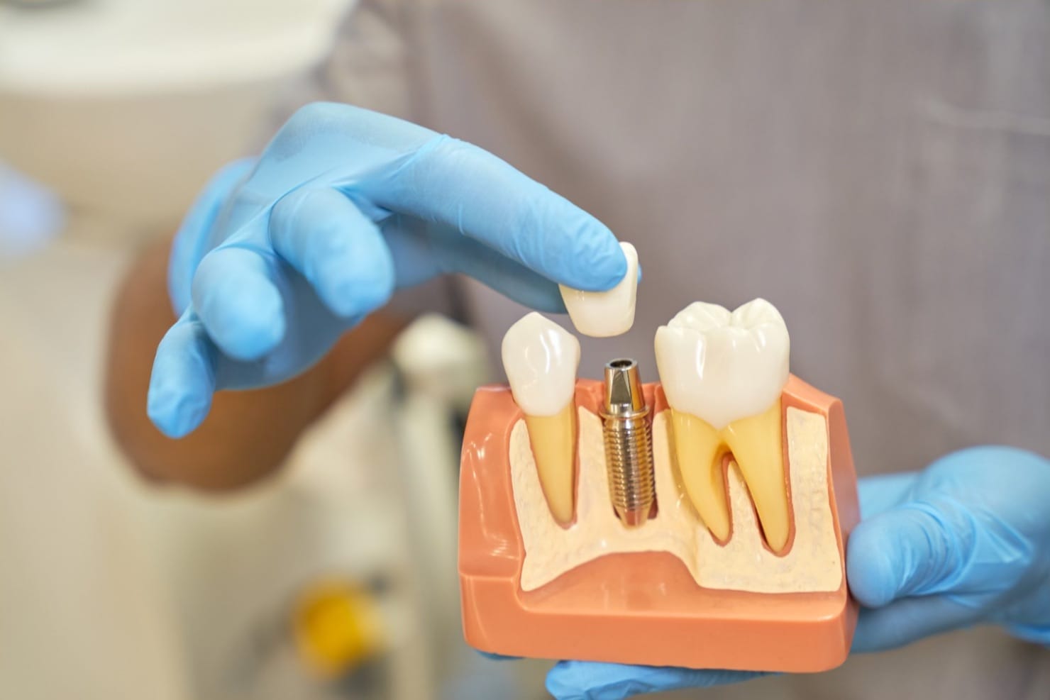 Stomatologie Constanta • Clinica Stomatologica constanta Respingerea implantului dentar: simptome, cauze și tratament pentru periimplantită și infecții dentare 1 Respingerea implantului dentar (medic stomatolog, macheta dentara, procedura de implantologie)