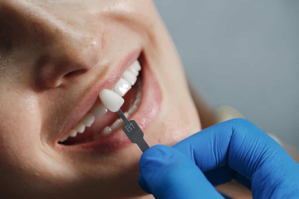 Sfaturi pentru menținerea rezultatelor albirii dentare - zambet dupa albirea dentara