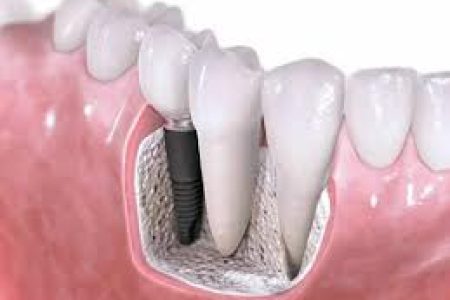 Totul despre implanturile dentare