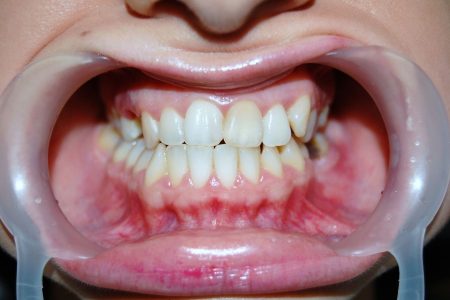 Dispozitiv dentar expune dinții albi strânși, gingii vizibile.